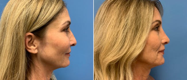 Rhinoplasty Before & After Gallery - Patient 38564644 - Image 1