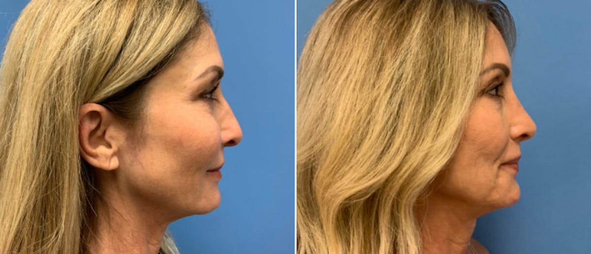 Rhinoplasty Before & After Gallery - Patient 38564644 - Image 1
