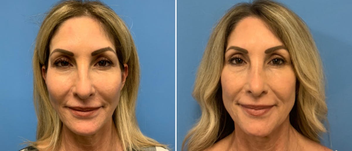 Rhinoplasty Before & After Gallery - Patient 38564644 - Image 2