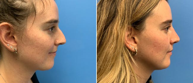 Rhinoplasty Before & After Gallery - Patient 38564646 - Image 1