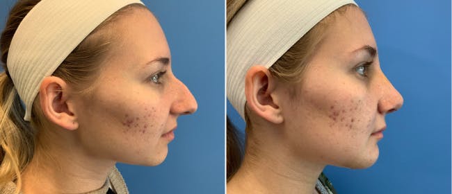 Rhinoplasty Before & After Gallery - Patient 38564647 - Image 1
