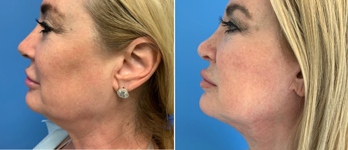 Rhinoplasty Before & After Gallery - Patient 38564648 - Image 1