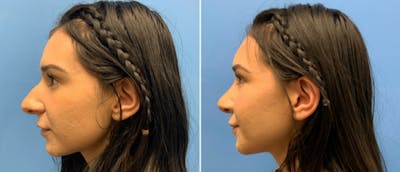 Rhinoplasty Before & After Gallery - Patient 38564654 - Image 1