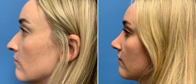 Rhinoplasty Before & After Gallery - Patient 38564655 - Image 1