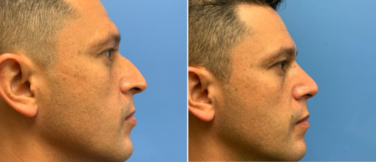 Rhinoplasty Before & After Gallery - Patient 38564656 - Image 1