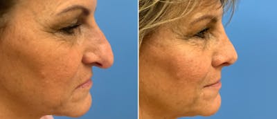 Rhinoplasty Before & After Gallery - Patient 38564657 - Image 1