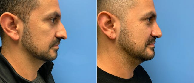 Rhinoplasty Before & After Gallery - Patient 38564658 - Image 1