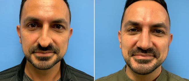 Rhinoplasty Before & After Gallery - Patient 38564658 - Image 2