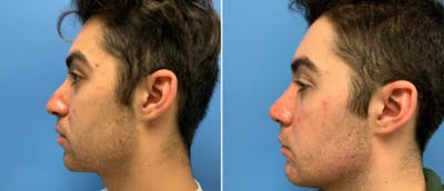 Rhinoplasty Before & After Gallery - Patient 38564660 - Image 1