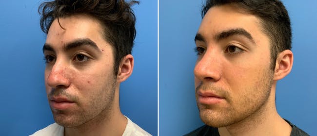 Rhinoplasty Before & After Gallery - Patient 38564660 - Image 2