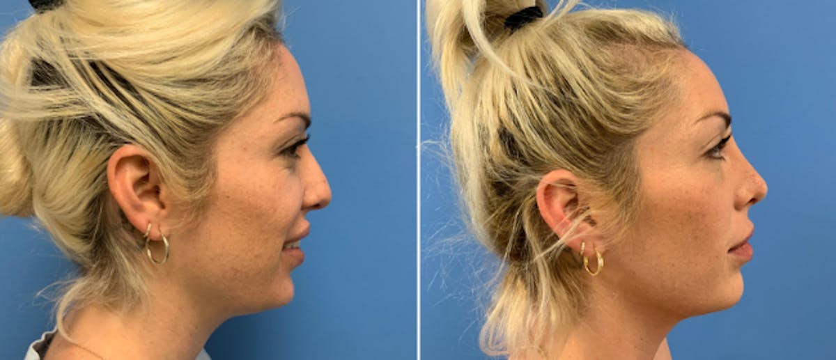 Rhinoplasty Before & After Gallery - Patient 38564662 - Image 1