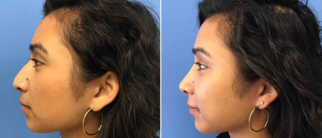 Rhinoplasty Before & After Gallery - Patient 38564663 - Image 1