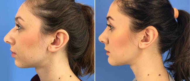 Rhinoplasty Before & After Gallery - Patient 38564664 - Image 1