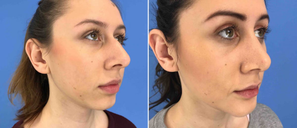 Rhinoplasty Before & After Gallery - Patient 38564664 - Image 2