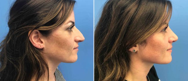 Rhinoplasty Before & After Gallery - Patient 38564667 - Image 1