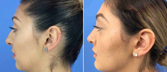 Rhinoplasty Before & After Gallery - Patient 38564668 - Image 1