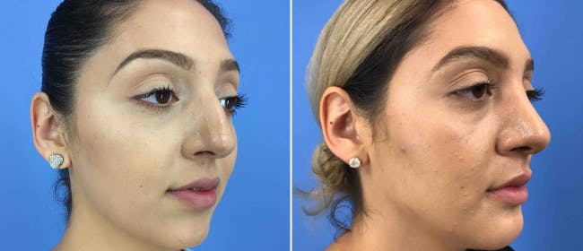 Rhinoplasty Before & After Gallery - Patient 38564668 - Image 2