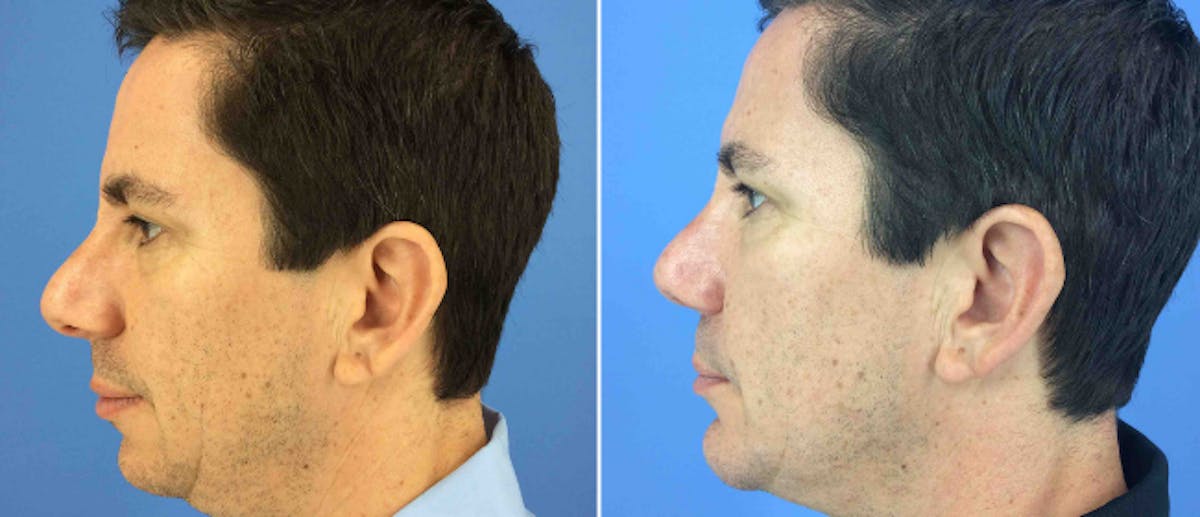 Rhinoplasty Before & After Gallery - Patient 38564670 - Image 1