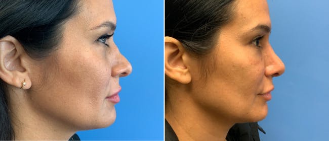 Rhinoplasty Before & After Gallery - Patient 38564671 - Image 1