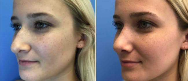 Rhinoplasty Before & After Gallery - Patient 38564672 - Image 1