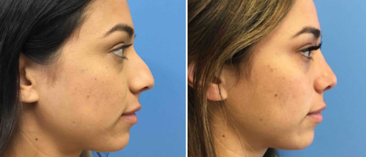 Rhinoplasty Before & After Gallery - Patient 38564673 - Image 1
