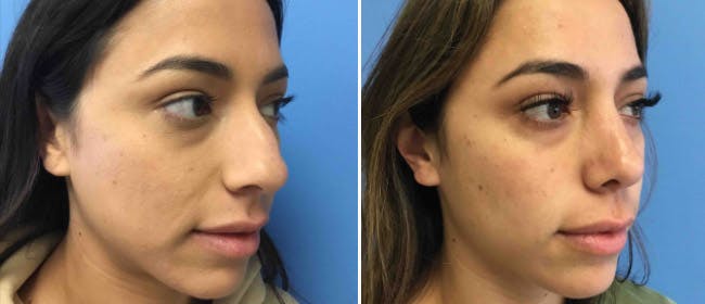 Rhinoplasty Before & After Gallery - Patient 38564673 - Image 2