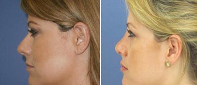 Rhinoplasty Before & After Gallery - Patient 38564675 - Image 1