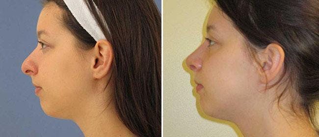 Rhinoplasty Before & After Gallery - Patient 38564676 - Image 1