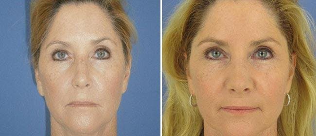 Rhinoplasty Before & After Gallery - Patient 38564678 - Image 1