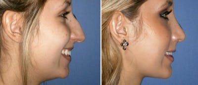 Rhinoplasty Before & After Gallery - Patient 38564679 - Image 1