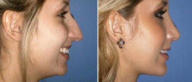 Rhinoplasty Before & After Gallery - Patient 38564679 - Image 1