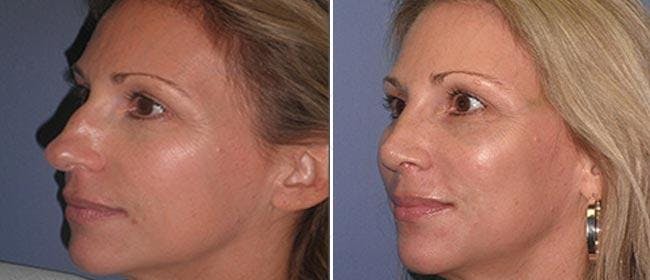 Rhinoplasty Before & After Gallery - Patient 38564681 - Image 1