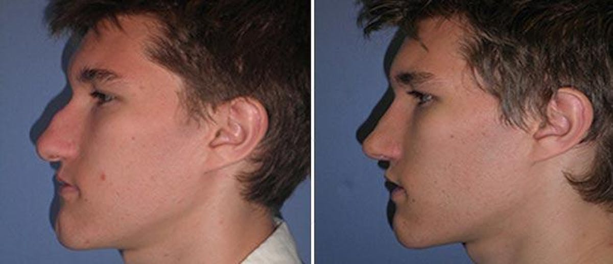 Rhinoplasty Before & After Gallery - Patient 38564682 - Image 1