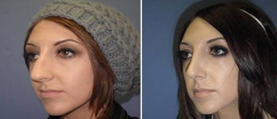 Rhinoplasty Before & After Gallery - Patient 38564683 - Image 1