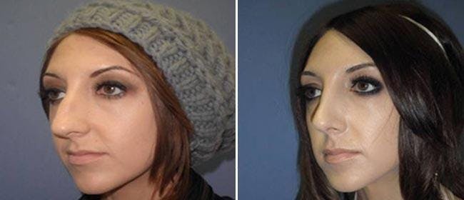 Rhinoplasty Before & After Gallery - Patient 38564683 - Image 1