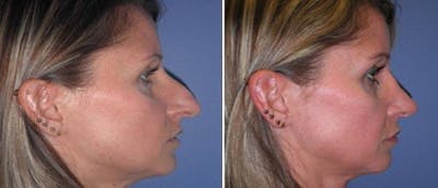 Rhinoplasty Before & After Gallery - Patient 38564684 - Image 1