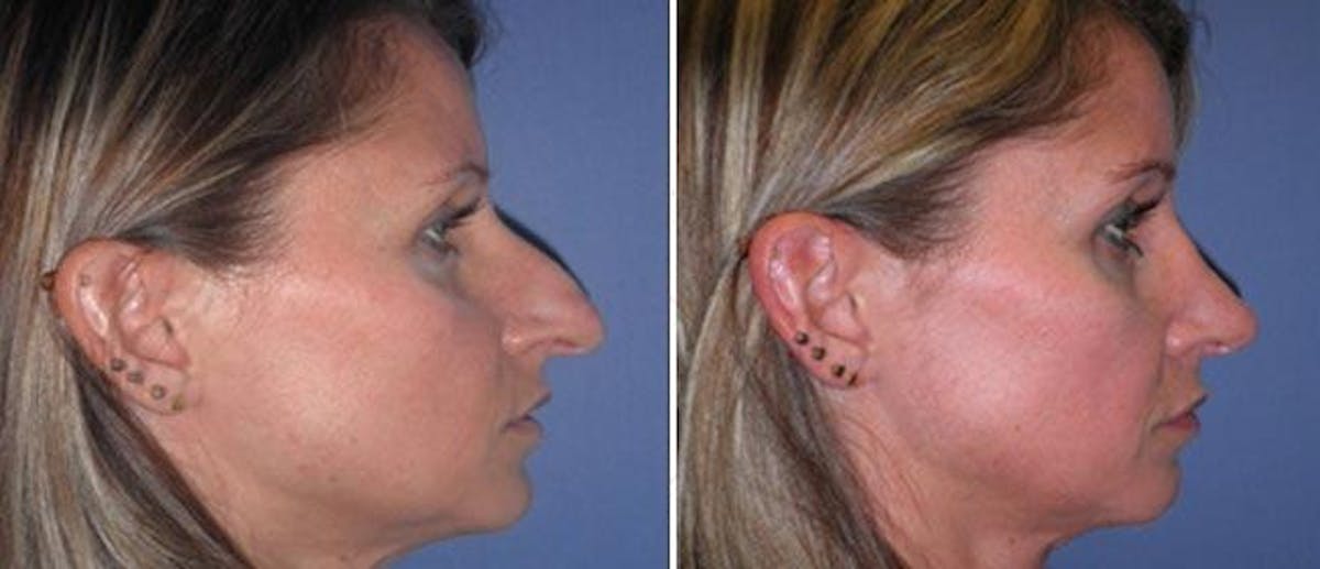 Rhinoplasty Before & After Gallery - Patient 38564684 - Image 1