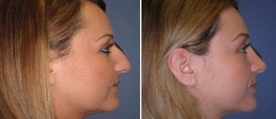 Rhinoplasty Before & After Gallery - Patient 38564685 - Image 1