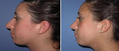 Rhinoplasty Before & After Gallery - Patient 38564686 - Image 1