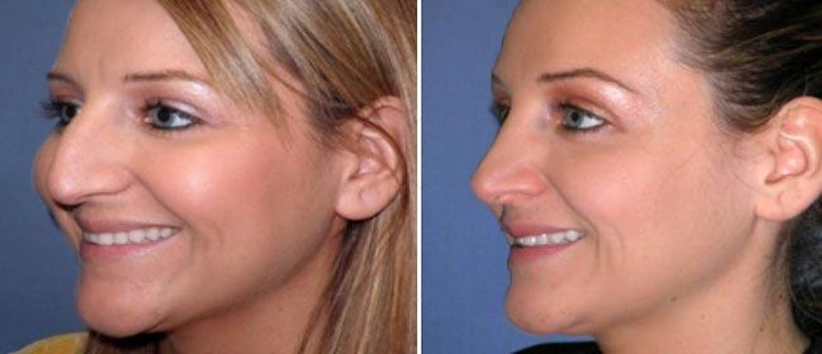 Rhinoplasty Before & After Gallery - Patient 38564685 - Image 2