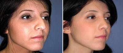 Rhinoplasty Before & After Gallery - Patient 38564688 - Image 1