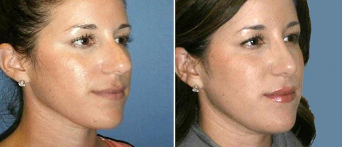 Rhinoplasty Before & After Gallery - Patient 38564689 - Image 1