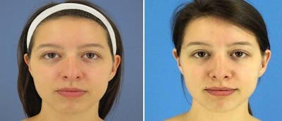 Rhinoplasty Before & After Gallery - Patient 38564690 - Image 1