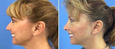 Rhinoplasty Before & After Gallery - Patient 38564692 - Image 1