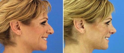 Rhinoplasty Before & After Gallery - Patient 38564693 - Image 1