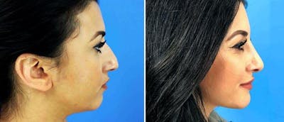 Rhinoplasty Before & After Gallery - Patient 38564705 - Image 1