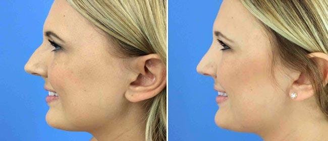 Rhinoplasty Before & After Gallery - Patient 38564706 - Image 1