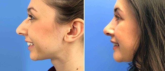 Rhinoplasty Before & After Gallery - Patient 38564707 - Image 1