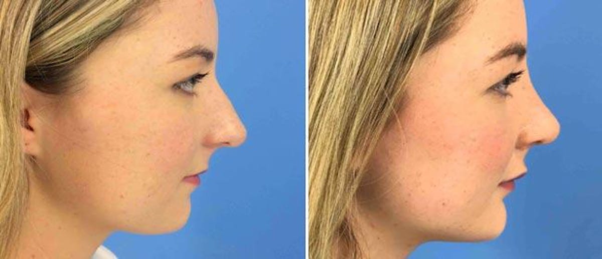 Rhinoplasty Before & After Gallery - Patient 38564708 - Image 1
