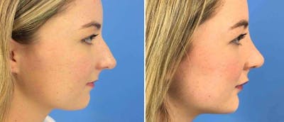 Rhinoplasty Before & After Gallery - Patient 38564708 - Image 1